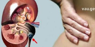 თუ შარდკენჭოვანი დაავადება გაქვთ და არ იცით რა მოიმოქმედოთ, გაგიზიარებთ გამორჩეულ რეცეპტს !