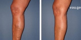 ვენების გაგანიერების დროს აუცილებლად მიმართეთ ამ ხერხს და სუდამოდ მადლიერი დარჩებით !