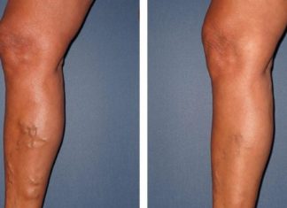 ვენების გაგანიერების დროს აუცილებლად მიმართეთ ამ ხერხს და სუდამოდ მადლიერი დარჩებით !