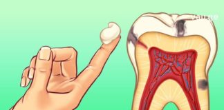 ეფექტური საშუალებები კბილის ტკივილისას – დროში გამოცდილი რეცეპტები