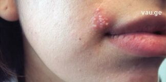 მომხმარებლის ნაამბობი, როგორ მოიცილა ჰერპესი სახლის პირობებში