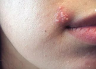 მომხმარებლის ნაამბობი, როგორ მოიცილა ჰერპესი სახლის პირობებში