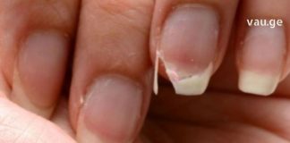 ეს წამალი უნდა მოამზადოთ, თუ ფრჩხილები მტვრევადი გაქვთ