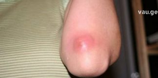 ამის შემდეგ სამუდამოდ განიკურნებით ძირმაგარასგან – დროში გამოცდილი რეცეპტები !