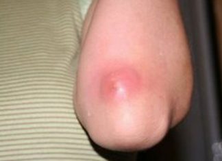 ამის შემდეგ სამუდამოდ განიკურნებით ძირმაგარასგან – დროში გამოცდილი რეცეპტები !