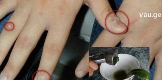 ჩემმა მეუღლემ მხოლოდ ამ მეთოდებით მოახერხა მეჭეჭების, ხალებისა და პაპილომების მოსაცილება !