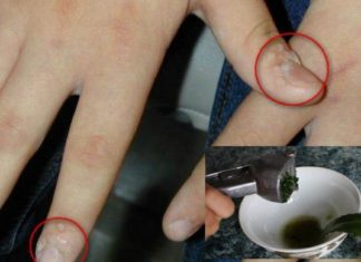 ჩემმა მეუღლემ მხოლოდ ამ მეთოდებით მოახერხა მეჭეჭების, ხალებისა და პაპილომების მოსაცილება !