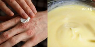 დახეთქილი კანის შველა არც ისე ძნელია : ამის შემდეგ სამუდამოდ განიკურნებით