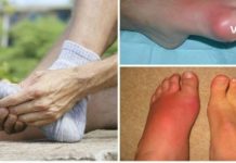 უკვე შესაძლებელია პოდაგრის გარეშე ცხოვრება – ეს ყველას გამოგადგებათ