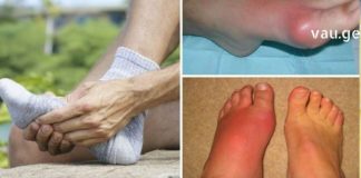 უკვე შესაძლებელია პოდაგრის გარეშე ცხოვრება – ეს ყველას გამოგადგებათ