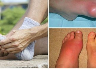 უკვე შესაძლებელია პოდაგრის გარეშე ცხოვრება – ეს ყველას გამოგადგებათ