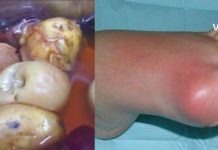 ჩემი დედამთილი დღესდღეობით ამ გამოცდილ მეთოდებს იყენებს და მდგომარეობა საგრძნობლად გაუმჯობესდა..