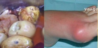 ჩემი დედამთილი დღესდღეობით ამ გამოცდილ მეთოდებს იყენებს და მდგომარეობა საგრძნობლად გაუმჯობესდა..