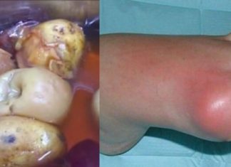 ჩემი დედამთილი დღესდღეობით ამ გამოცდილ მეთოდებს იყენებს და მდგომარეობა საგრძნობლად გაუმჯობესდა..