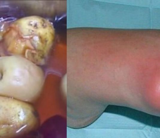 ჩემი დედამთილი დღესდღეობით ამ გამოცდილ მეთოდებს იყენებს და მდგომარეობა საგრძნობლად გაუმჯობესდა..