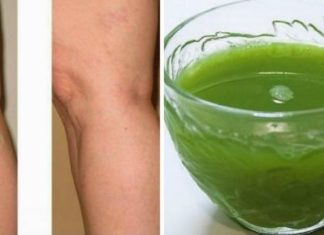 გსურთ ისე გაატაროთ ცხოვრება, რომ არასდროს შეგაწუხოთ ვენების ვარიკოზულმა გაგანიერებამ ? – ბუნებრივი შემადგენლობა, რომელიც ადვილად დაგეხმარებათ!