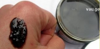 6 ფაქტი ფსორიაზის შესახებ: რა უნდა იცოდეთ ამ დაავადების შესახებ და როგორ უნდა იმკურნალოდ მარტივად სახლში?!