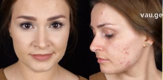 ეფექტური და სწრაფად მოქმედი რეცეპტები, რომელთა ინგრედიენტებს ძალიან იაფად შეიძენთ აფთიაქში თუ სახლში არ გაქვთ!