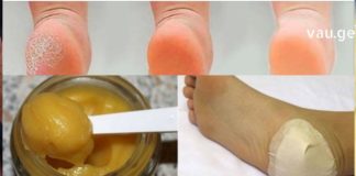 ბებიამ სულ რაღაც ერთ ღამეში მომირჩინა დამსკდარი ქუსლები – როგორც იქნა ღია ფეხსაცმლის ჩაცმა შევძელი !