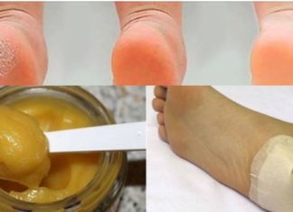 ბებიამ სულ რაღაც ერთ ღამეში მომირჩინა დამსკდარი ქუსლები – როგორც იქნა ღია ფეხსაცმლის ჩაცმა შევძელი !