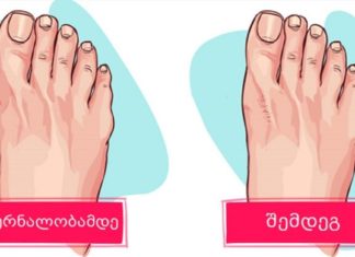 ერთ-ერთი კლინიკის ექთანმა საიდუმლოდ ჩამაწერინა გამოწეული ძვლის მოსაშორებელი საშუალება