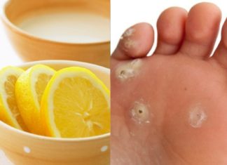 სულ რაღაც 10 წუთი და მაზოლებისგან გათავისუფლდებით ყოველგვარი ძალისხმევის გარეშე – მუდმივი პრობლემის გადაჭრა სწრაფად და ეფექტურად !