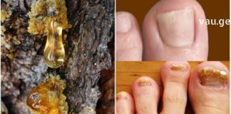 ამ მამაკაცის მაგალითი ნათლად აჩვენებს, თუ როგორ შეიძლება სოკოს დაავადების 100%-ით განკურნება !