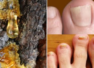 ამ მამაკაცის მაგალითი ნათლად აჩვენებს, თუ როგორ შეიძლება სოკოს დაავადების 100%-ით განკურნება !