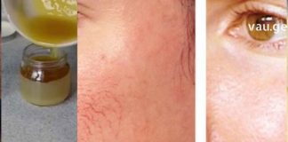 სახიდან არასასურველი კაპილარების გაქრობა 4 დადასტურებული და დროში გამოცდილი მეთოდით !