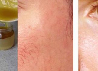 სახიდან არასასურველი კაპილარების გაქრობა 4 დადასტურებული და დროში გამოცდილი მეთოდით !