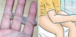 საუკეთესო გზა ბუასილის სამკურნალოდ: ეს ინგრედიენტები ყოველთვის თქვენს სამზარეულოშია და თქვენ ეს არ იცოდით