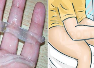 საუკეთესო გზა ბუასილის სამკურნალოდ:  ეს ინგრედიენტები ყოველთვის თქვენს სამზარეულოშია და თქვენ ეს არ იცოდით