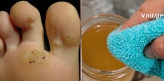 ყველაზე იაფი და ეფექტური გზებით მოიცილებთ მეჭეჭს, აკნეს და ასაკობრივ ლაქებს პირველი გამოყენების შემდეგ