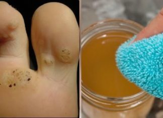 ყველაზე იაფი და ეფექტური გზებით მოიცილებთ მეჭეჭს, აკნეს და ასაკობრივ ლაქებს პირველი გამოყენების შემდეგ