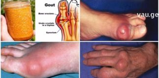 Როგორ გამოვდევნოთ ორგანიზმიდან შარდმჟავას კრისტალები რათა საბოლოოდ მოვიცილოთ პოდაგრა! რჩევები და რეცეპტები!
