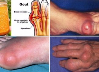 Როგორ გამოვდევნოთ ორგანიზმიდან შარდმჟავას კრისტალები რათა საბოლოოდ მოვიცილოთ პოდაგრა! რჩევები და რეცეპტები!