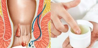 Სახლში მკურნალობა: მოიცილეთ ჰემოროიდული კვანძები თქვენს სამზარეულოში არსებული ერთი ინგრედიენტით სულ რაღაც რამდენიმე დღეში