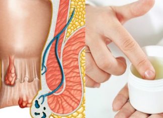 Სახლში მკურნალობა: მოიცილეთ ჰემოროიდული კვანძები თქვენს სამზარეულოში არსებული ერთი ინგრედიენტით სულ რაღაც რამდენიმე დღეში