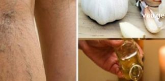 ხალხური შეუდარებელი რეცეპტები მათთვის, ვისაც ვენები აწუხებს!