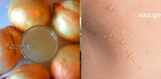 თუ ამას გააკეთებთ, 1 სუფრის კოვზიც კი საკმარისი იქნება, რომ ამოფხვრას პაპილომა უმოკლეს დროში!!