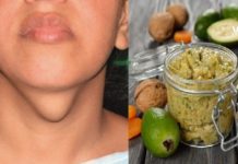 გახდი საკუთარი თავის ექიმი! ჩიყვის მკურნალობის 7 მარტივი გზა სახლის პირობებში!
