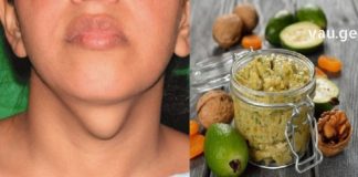 გახდი საკუთარი თავის ექიმი! ჩიყვის მკურნალობის 7 მარტივი გზა სახლის პირობებში!