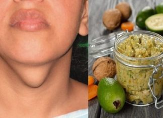 გახდი საკუთარი თავის ექიმი! ჩიყვის მკურნალობის 7 მარტივი გზა სახლის პირობებში!