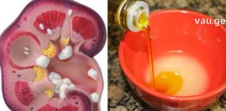 თირკმლის კენჭების პროფილაქტიკა ამ საშუალებებით ყველაზე მარტივია! აი როგორ უნდა მოიქცეთ ამ დროს!