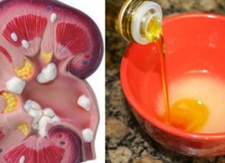 თირკმლის კენჭების პროფილაქტიკა ამ საშუალებებით ყველაზე მარტივია! აი როგორ უნდა მოიქცეთ ამ დროს!