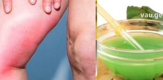 თრომბოზის მკურნალობის სწრაფი და ეფექტური მეთოდი – ამის შესახებ ყველამ უნდა გაიგოს!