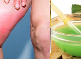 თრომბოზის მკურნალობის სწრაფი და ეფექტური მეთოდი – ამის შესახებ ყველამ უნდა გაიგოს!