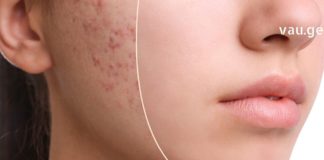 3 საუკეთესო ნიღაბი აკნესთან საბრძოლველად! მოამზადეთ დღესვე და შედეგი გაგაოცებთ!