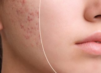 3 საუკეთესო ნიღაბი აკნესთან საბრძოლველად! მოამზადეთ დღესვე და შედეგი გაგაოცებთ!