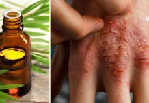 ეს უნივერსალური ზეთი ნამდვილი დამხმარეა – ფსორიაზი და ჰერპესი ამის წყალობით დავამარცხე!